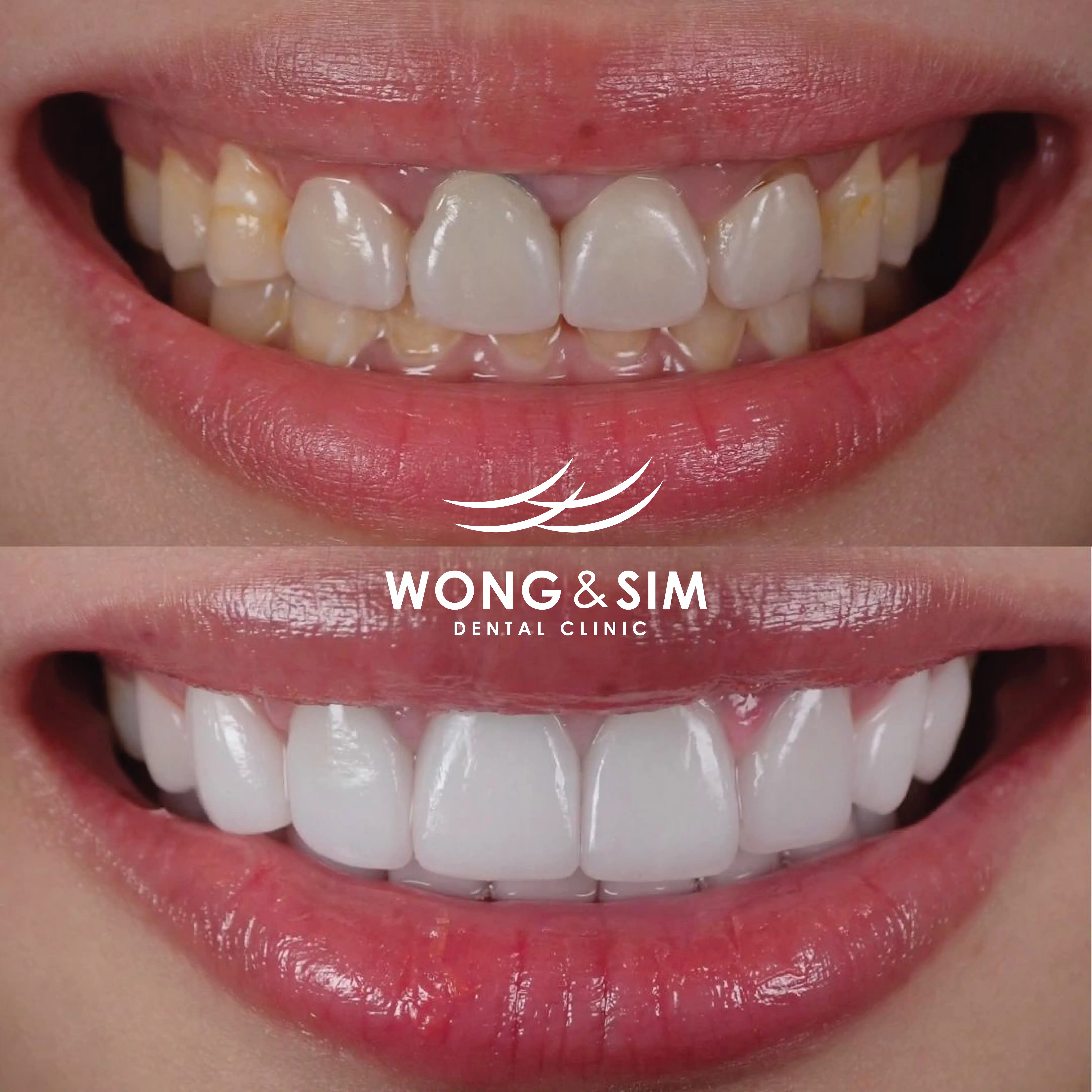 Patient 11 - Dental Implants Before and After